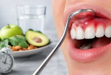 Cercetătorii au descoperit o legătură între post și ameliorarea inflamației gingiilor 8