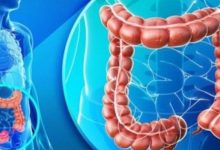 Cancerul colorectal, în creștere alarmantă la adulții tineri: semnele de alarmă pe care medicii spun să nu le ignori 8